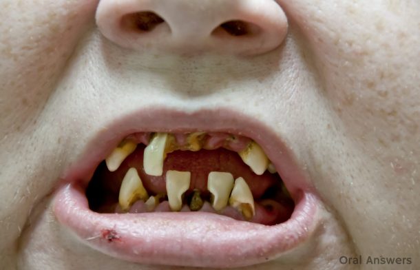 meth_mouth_destroys_teeth